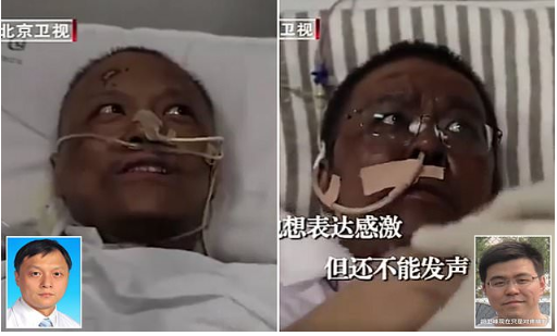 Chinese Doctors skin turn dark after the virus damaged their livers
